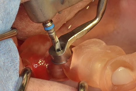 ガイデットサージェリーによる形成