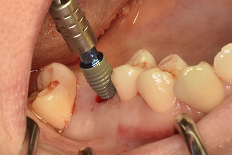 インプラント埋入