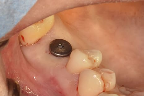 縫合しない低侵襲な術後